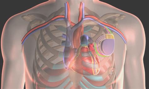 left ventricular pacing therapy